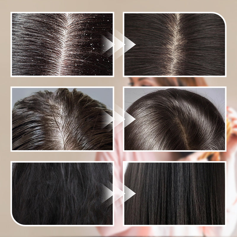 Shampoo de Azufre Control de Grasa y Anticaspa